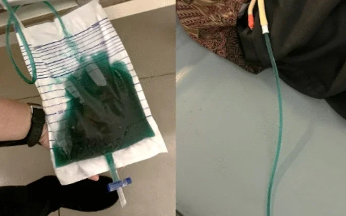 Published specimen photographs showing dark blue-green urine in a drainage bag and tubing.